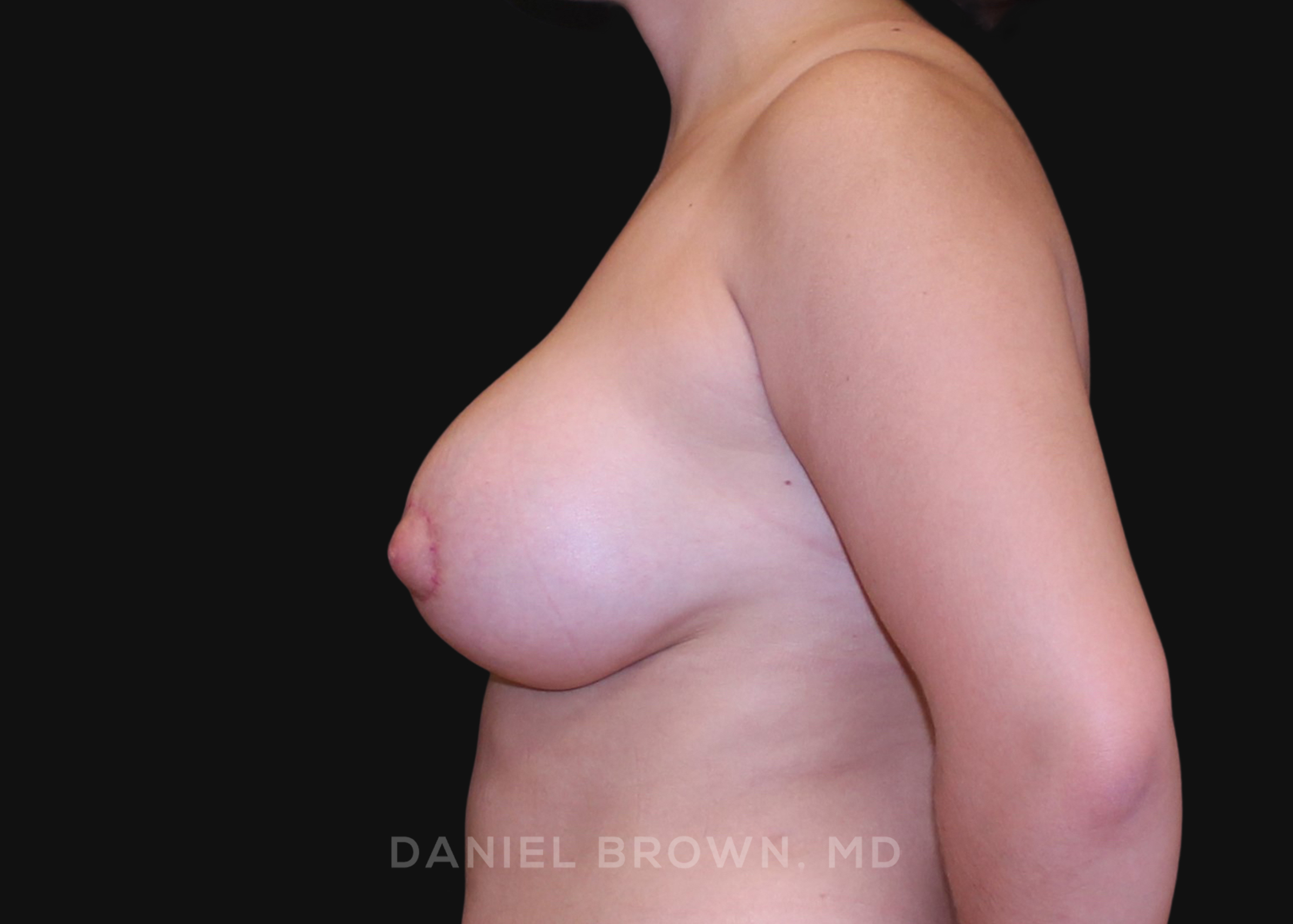 Periareolar Breast Lift/Aug Patient Photo - Case 1326 - after view-3