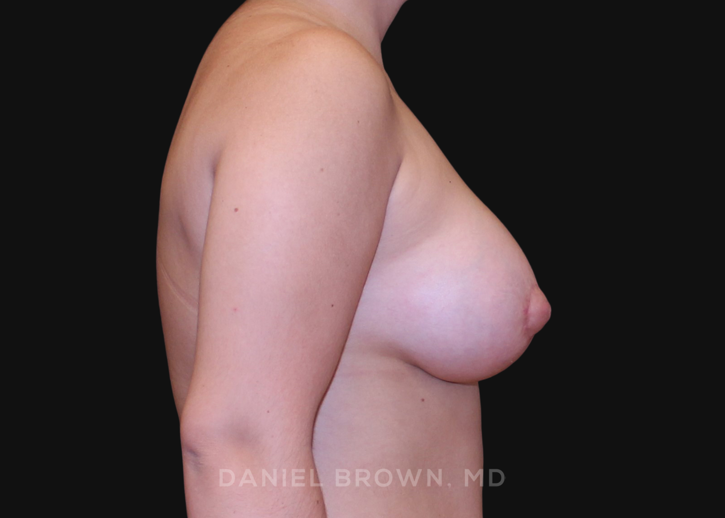 Periareolar Breast Lift/Aug Patient Photo - Case 1326 - after view-4