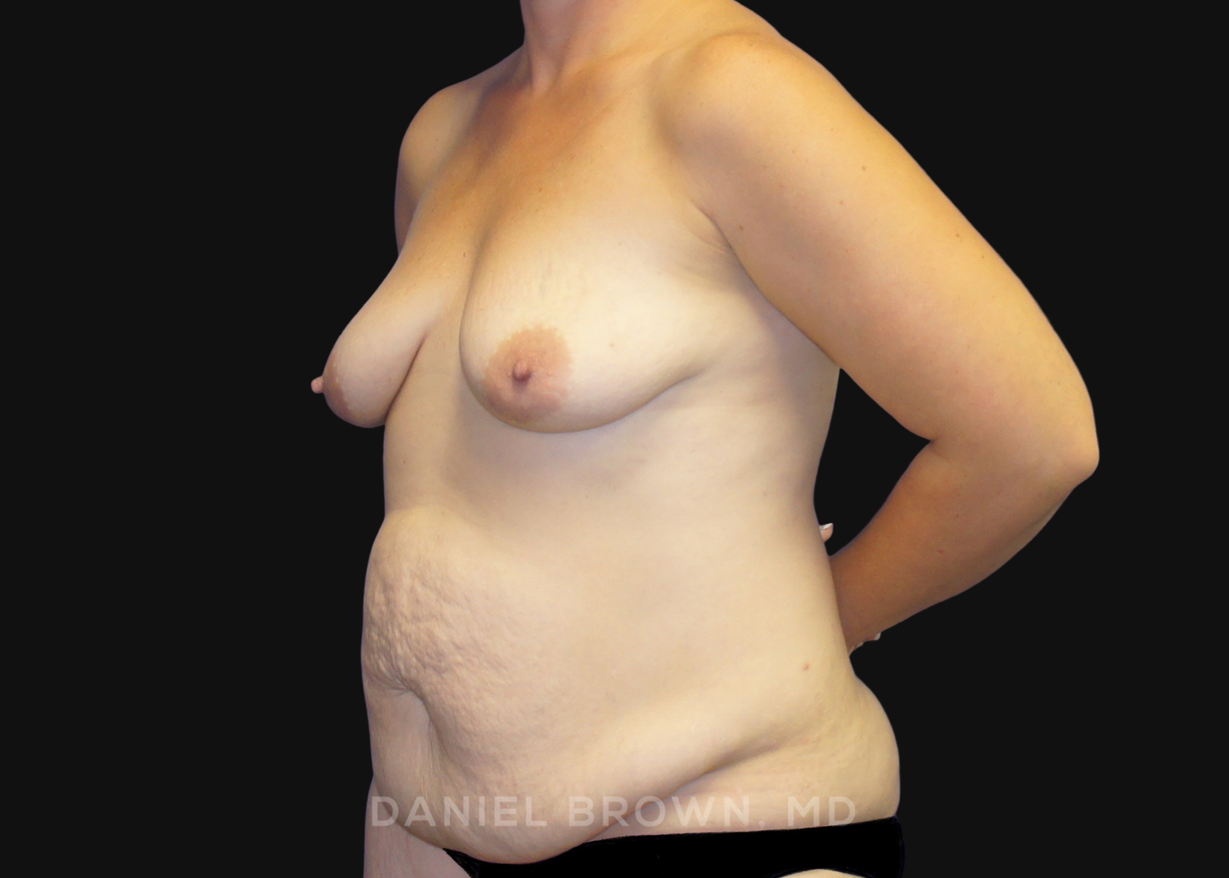 Mommy Makeover Patient Photo - Case 1338 - before view-
