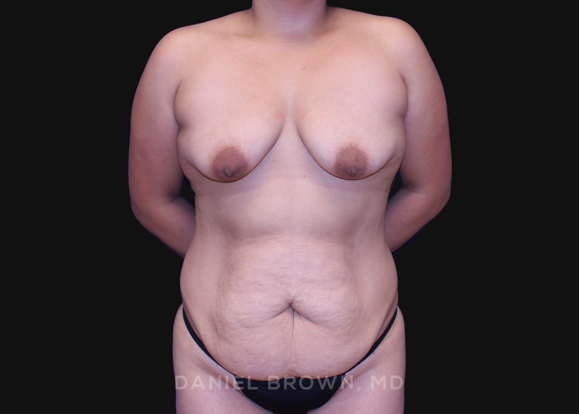 Mommy Makeover Patient Photo - Case 1358 - before view-