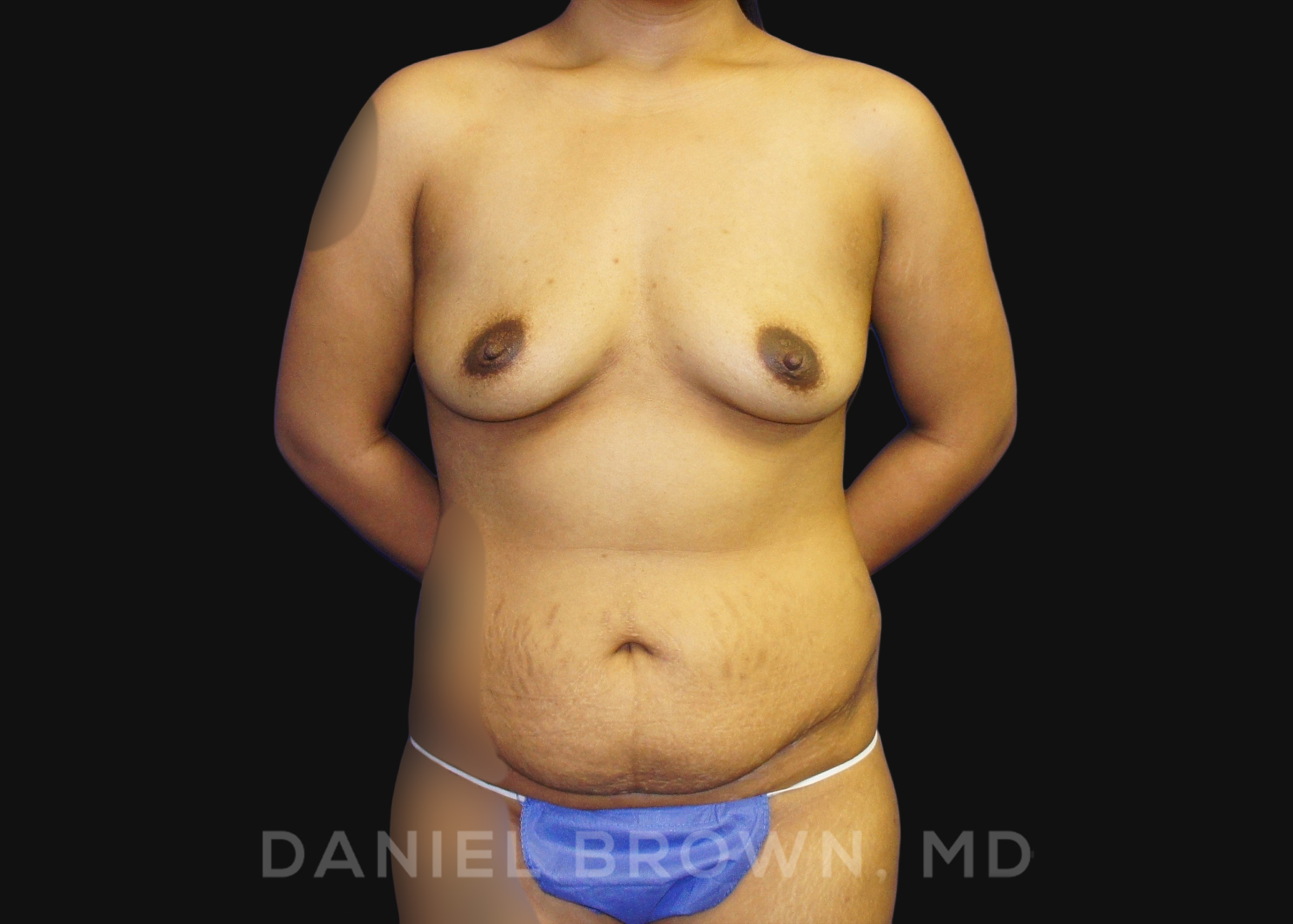Mommy Makeover Patient Photo - Case 1372 - before view-