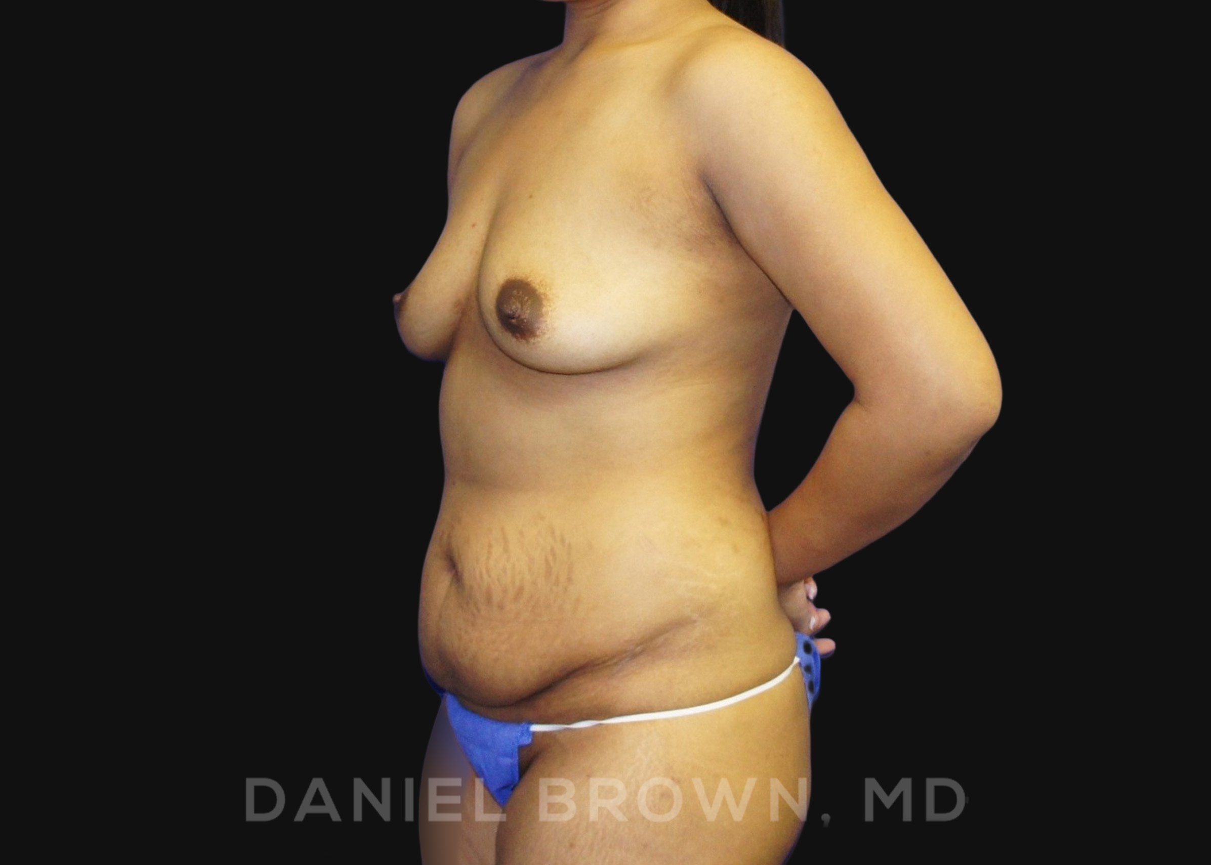 Mommy Makeover Patient Photo - Case 1372 - before view-