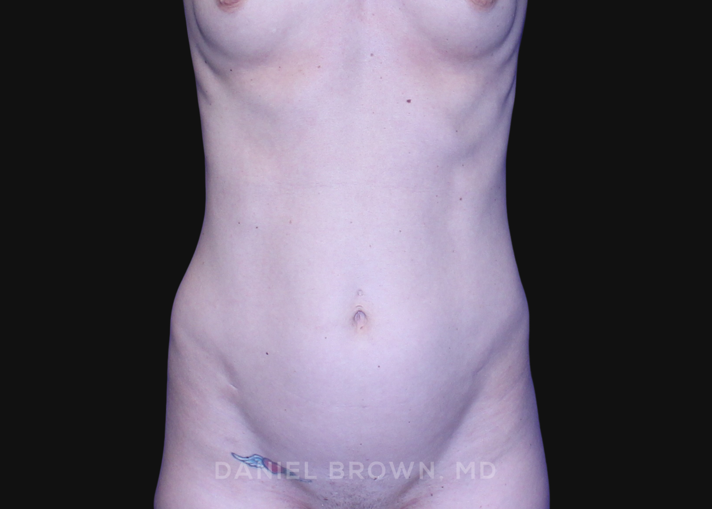 Mini Tummy Tuck Patient Photo - Case 1584 - before view-0