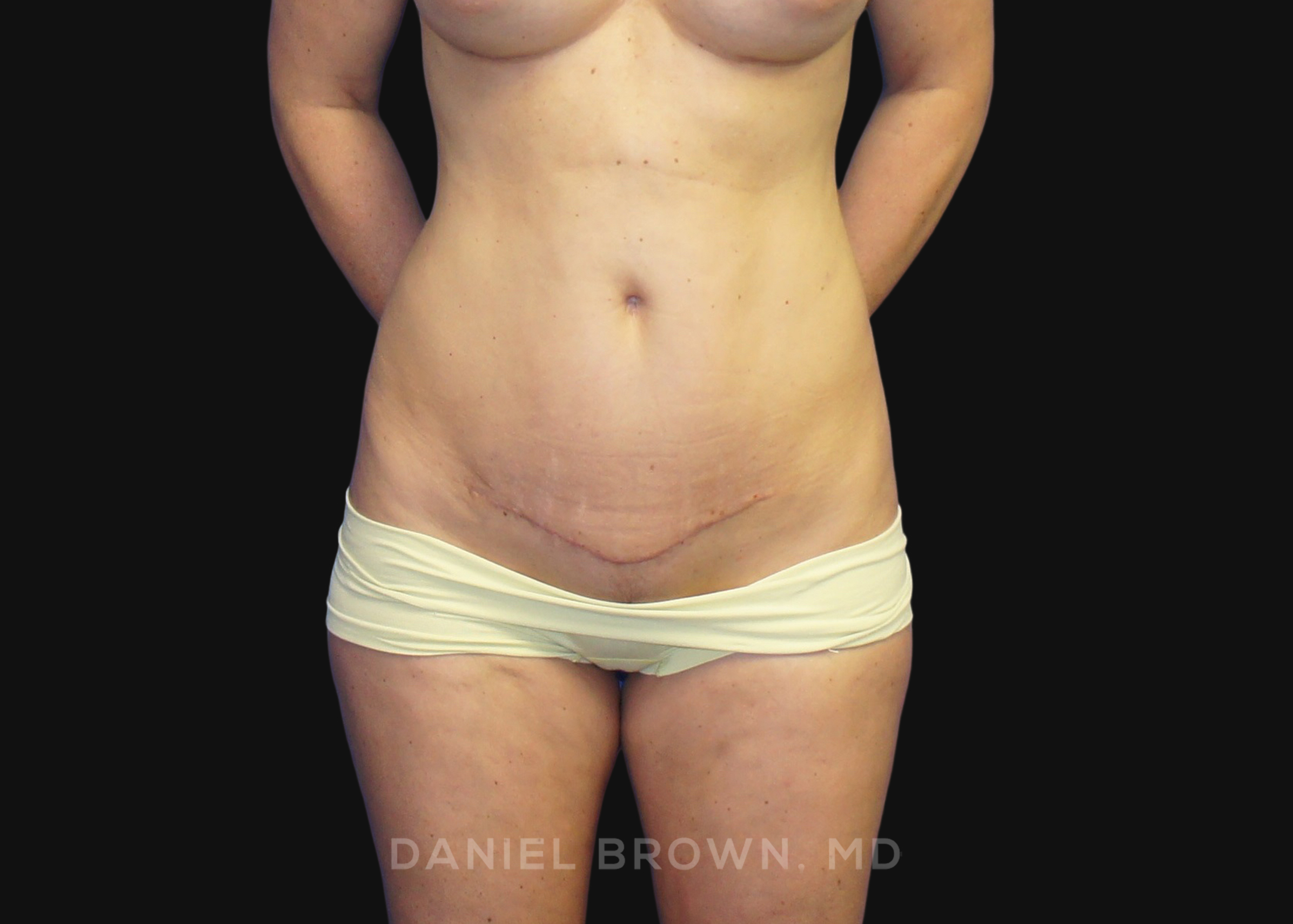 Mini Tummy Tuck Patient Photo - Case 1593 - after view-0
