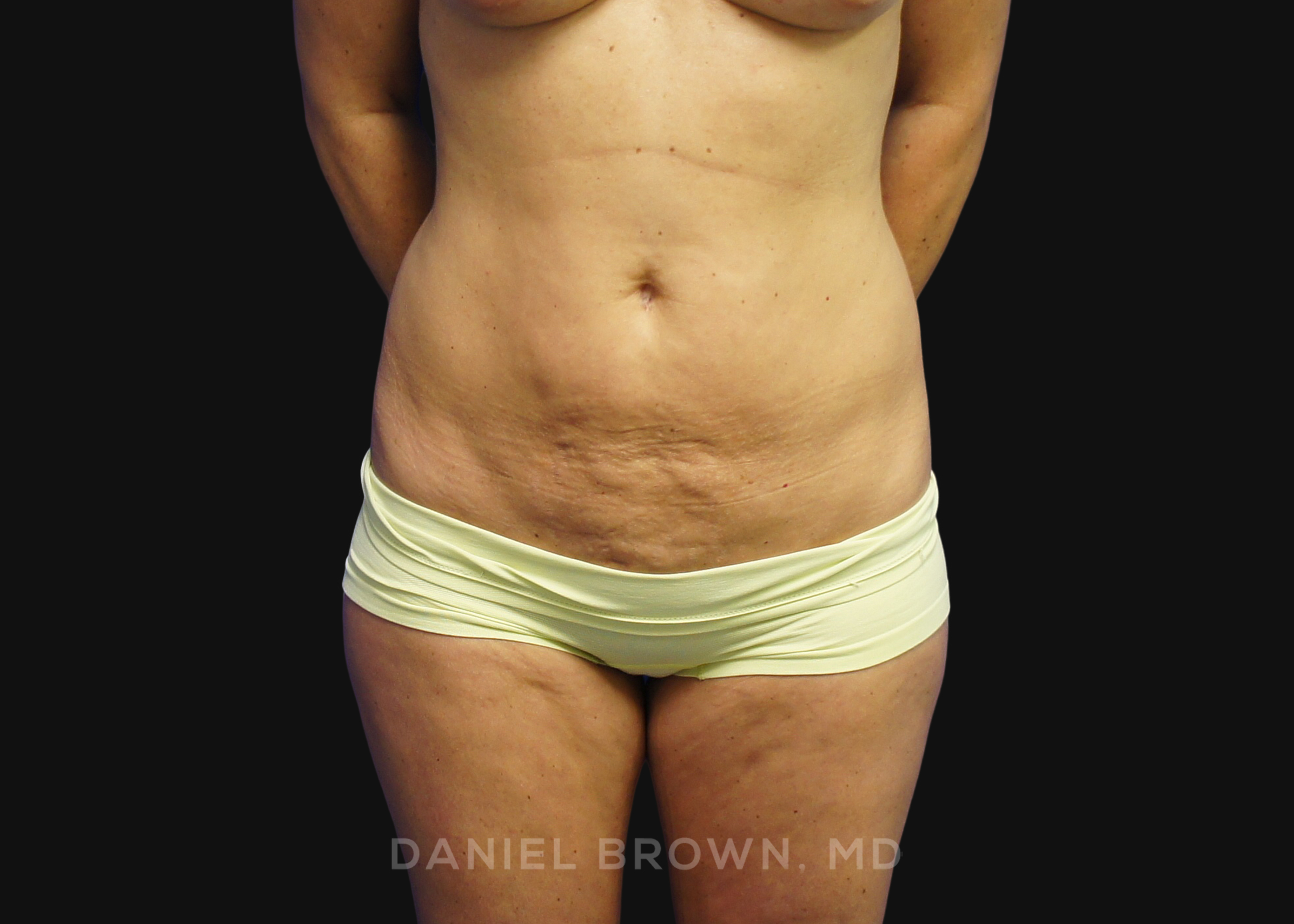 Mini Tummy Tuck Patient Photo - Case 1593 - before view-
