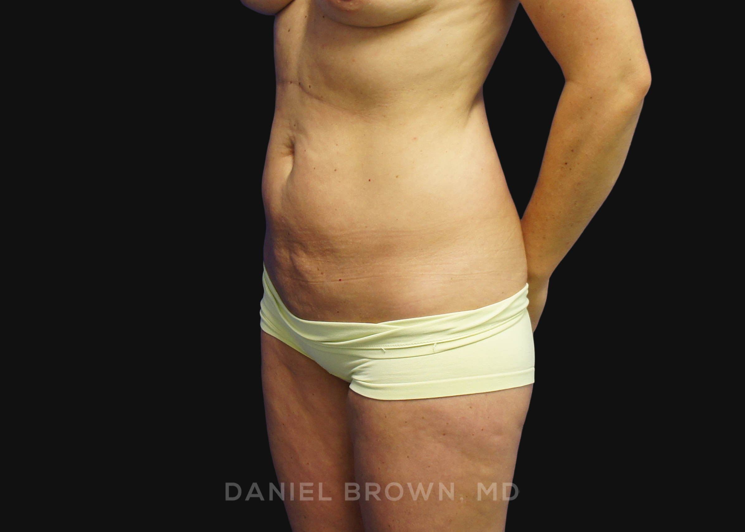 Mini Tummy Tuck Patient Photo - Case 1593 - before view-