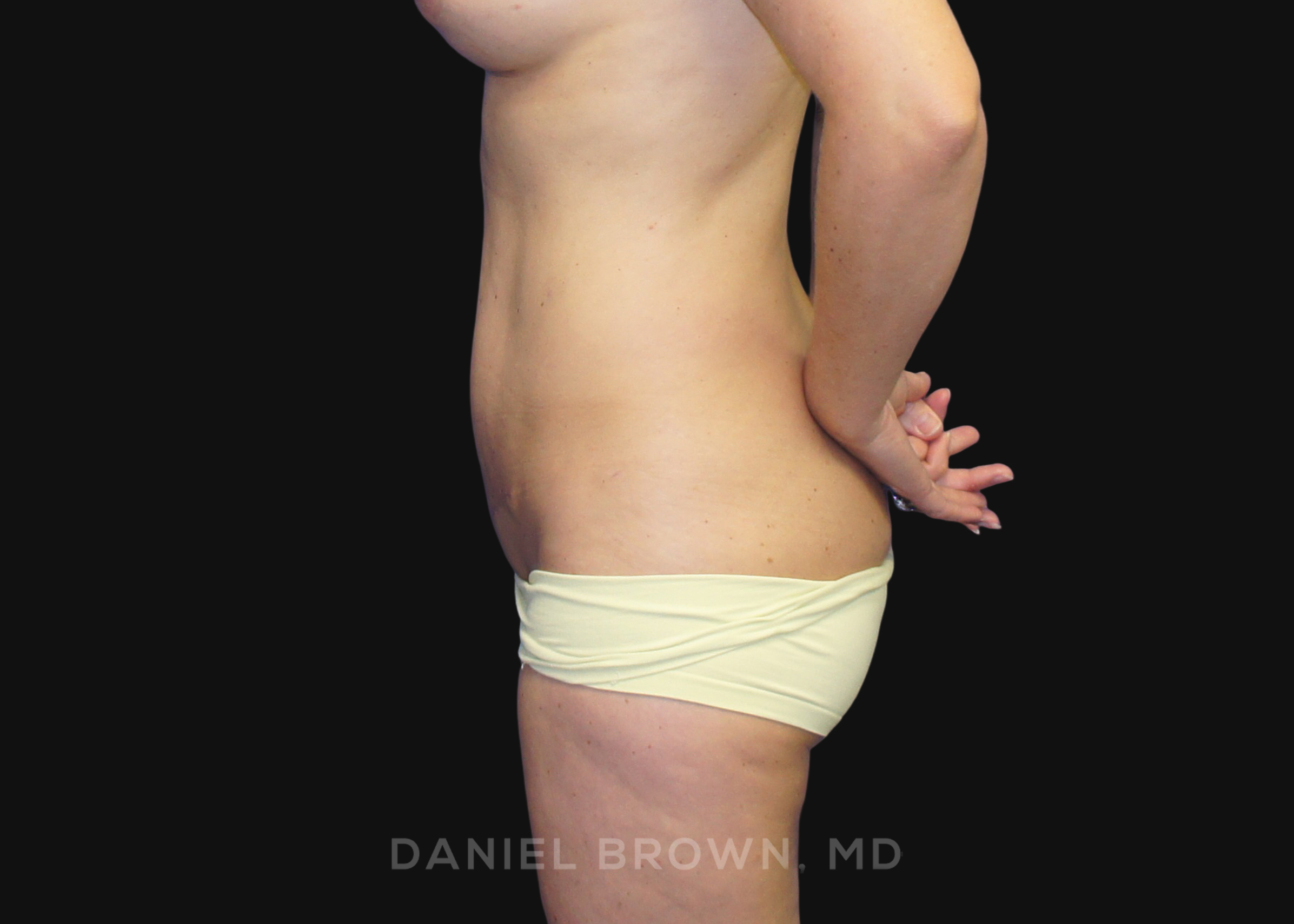 Mini Tummy Tuck Patient Photo - Case 1593 - after view