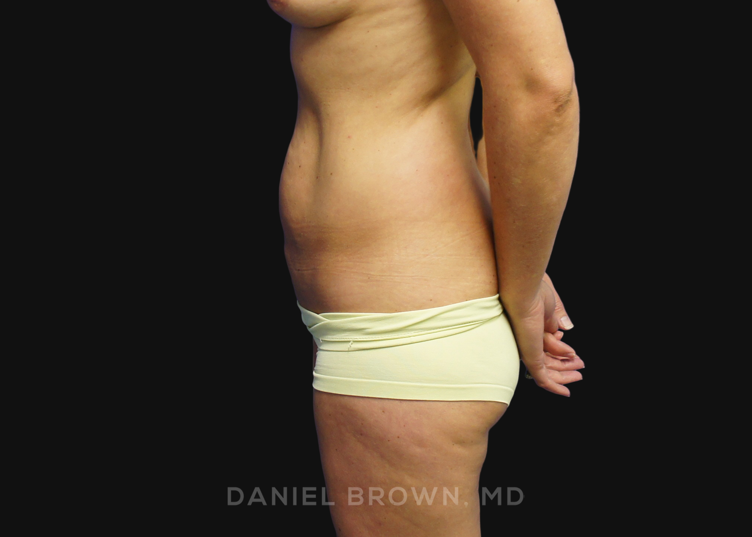 Mini Tummy Tuck Patient Photo - Case 1593 - before view-3