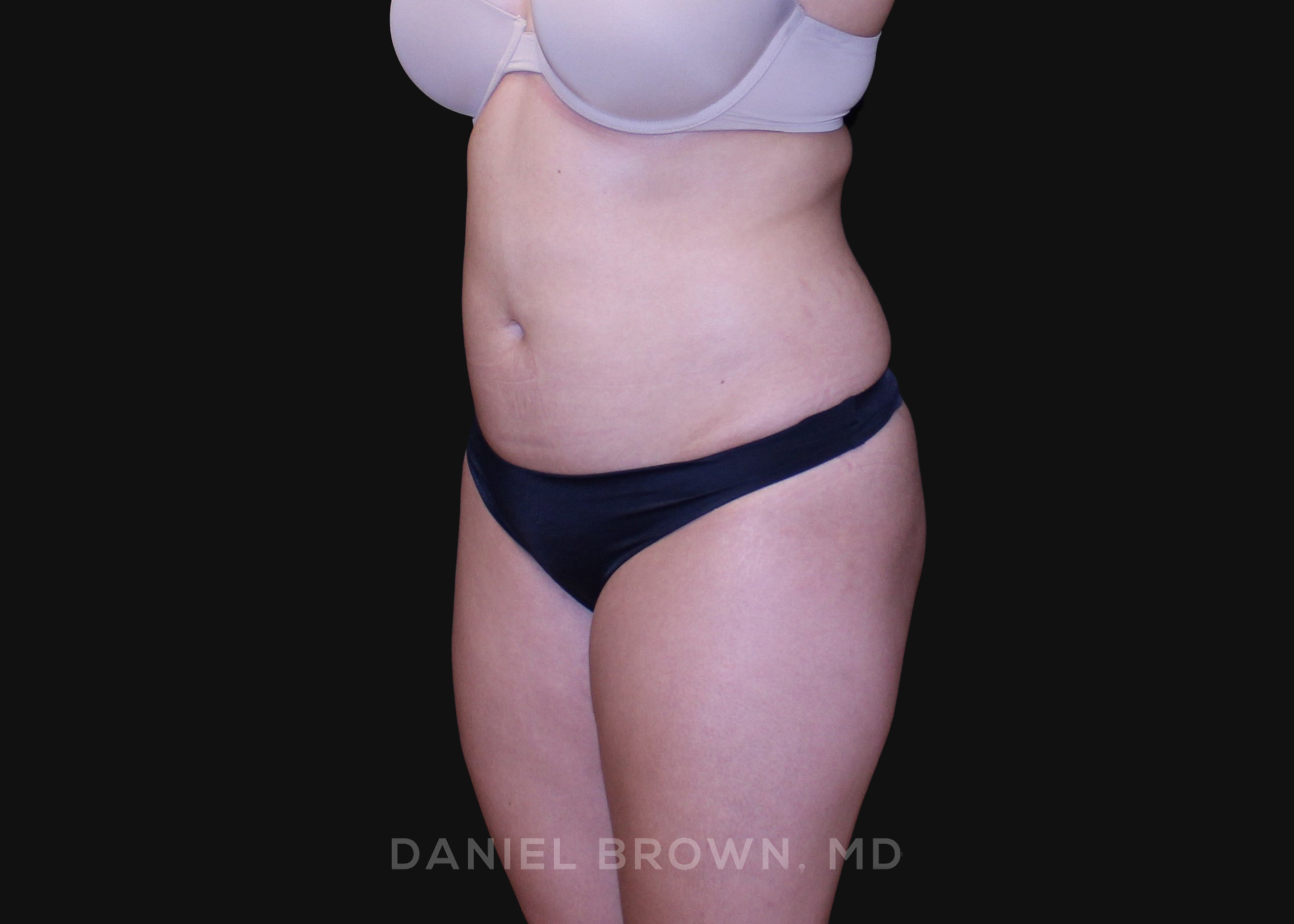 Liposuction Patient Photo - Case 1604 - before view-1