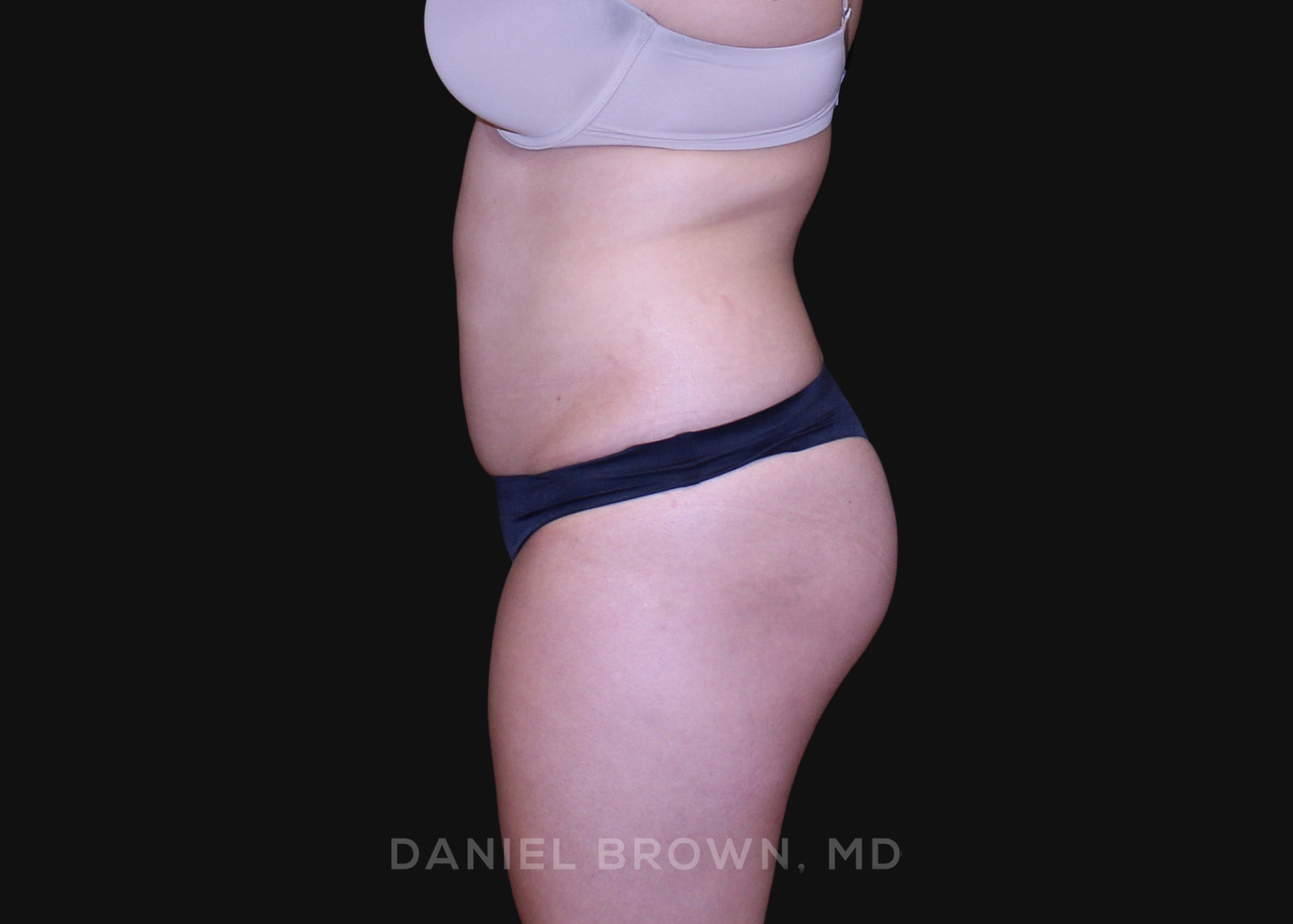 Liposuction Patient Photo - Case 1604 - before view-