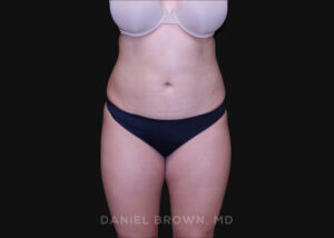 Liposuction - Case 1604 - Before