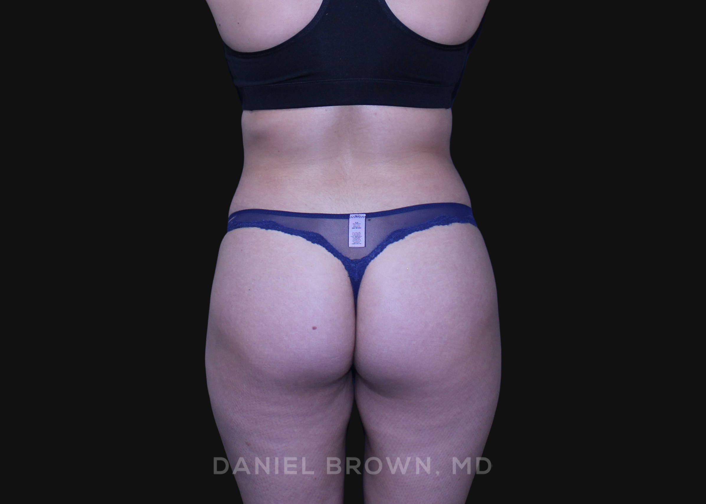 Liposuction Patient Photo - Case 1604 - after view-5