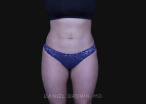 Liposuction - Case 1604 - After