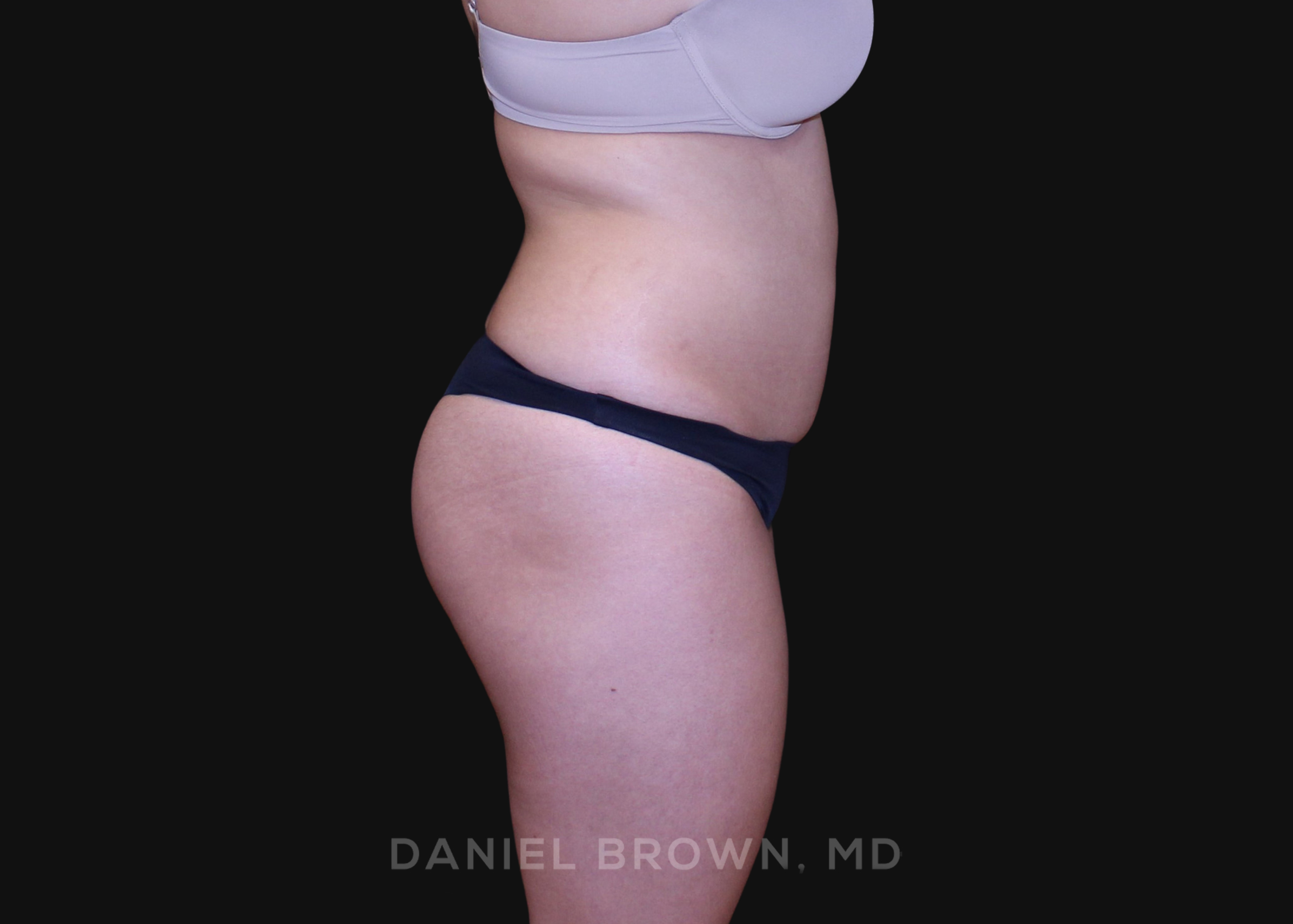 Liposuction Patient Photo - Case 1604 - before view-