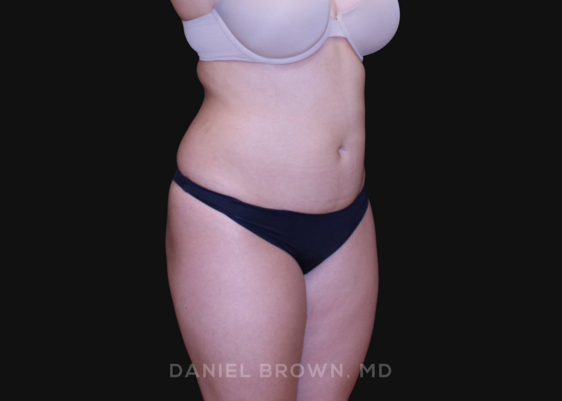 Liposuction Patient Photo - Case 1604 - before view-2