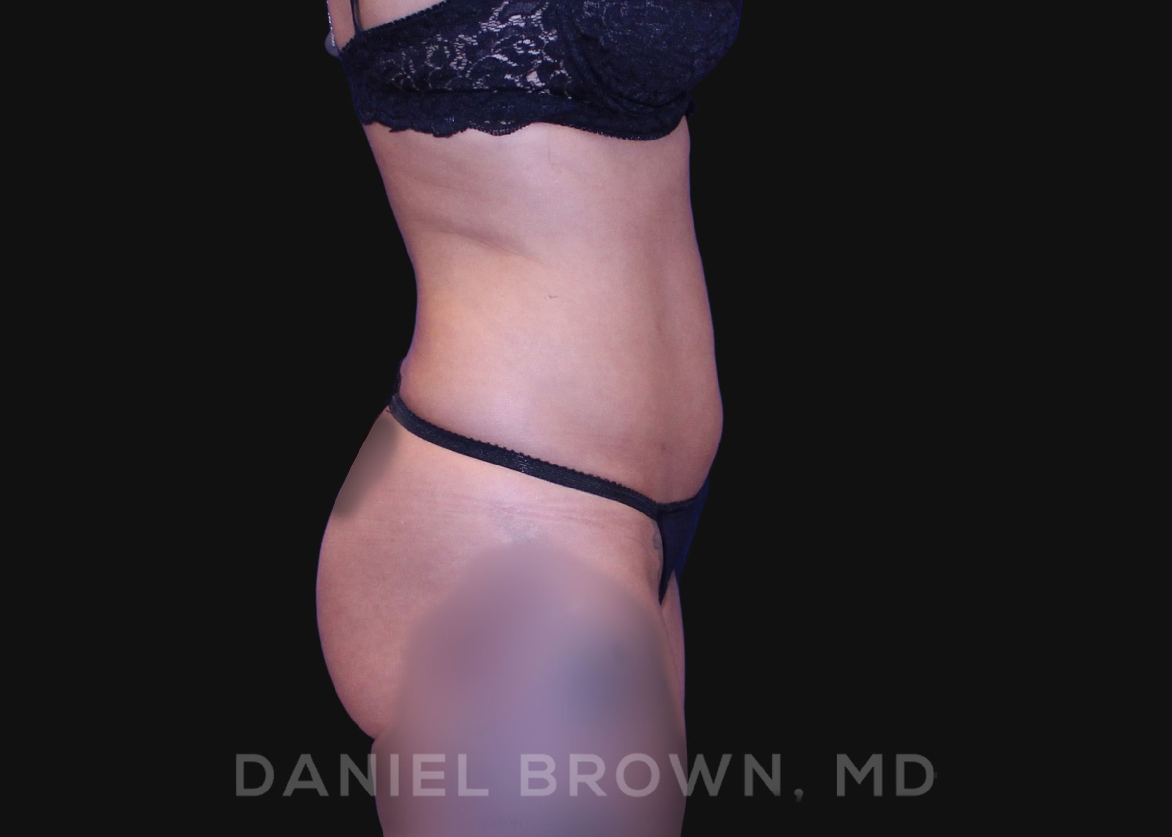 Liposuction Patient Photo - Case 1617 - after view-4