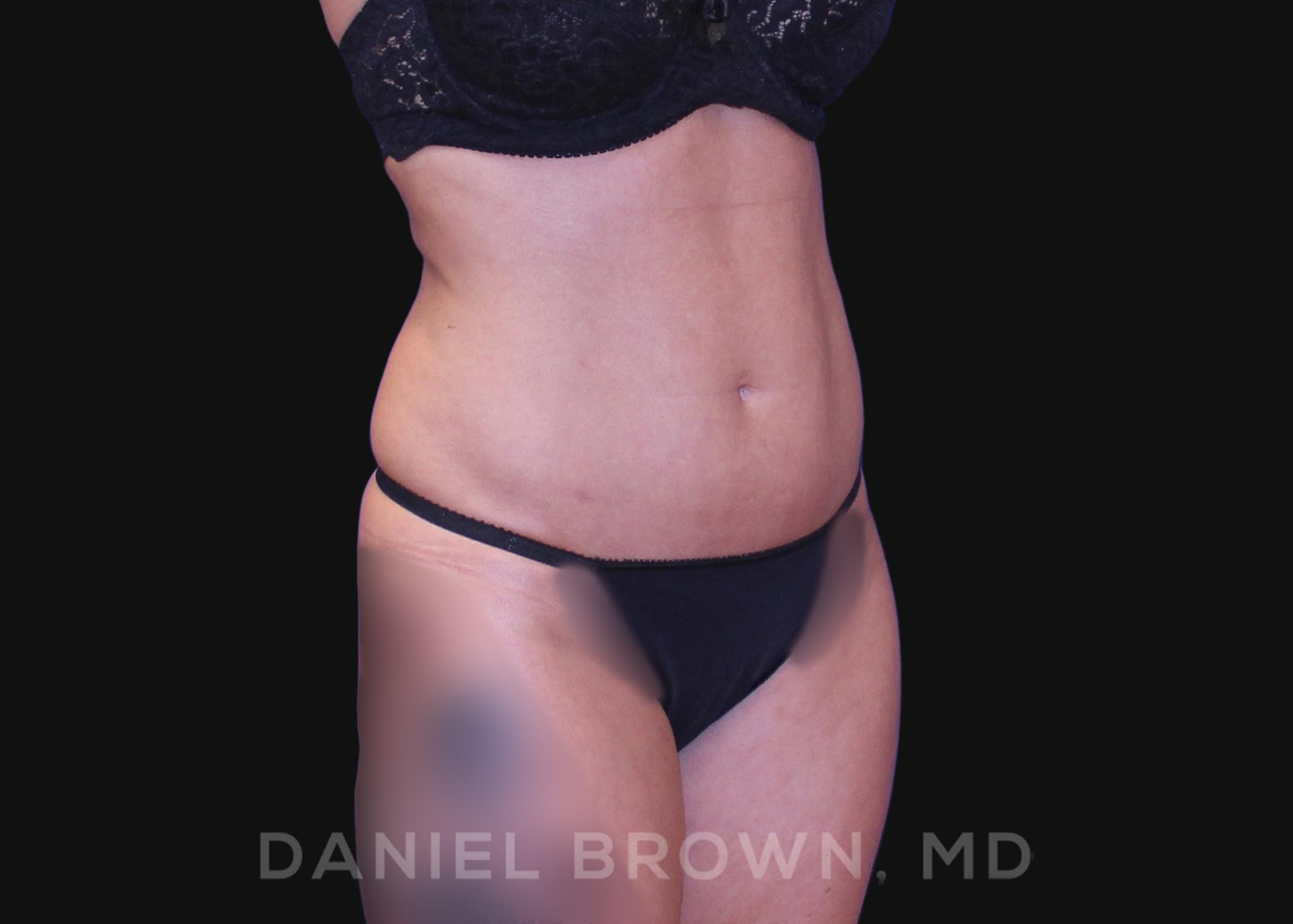 Liposuction Patient Photo - Case 1617 - after view