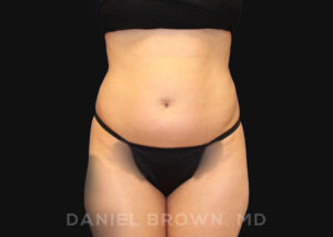 Liposuction - Case 1617 - Before