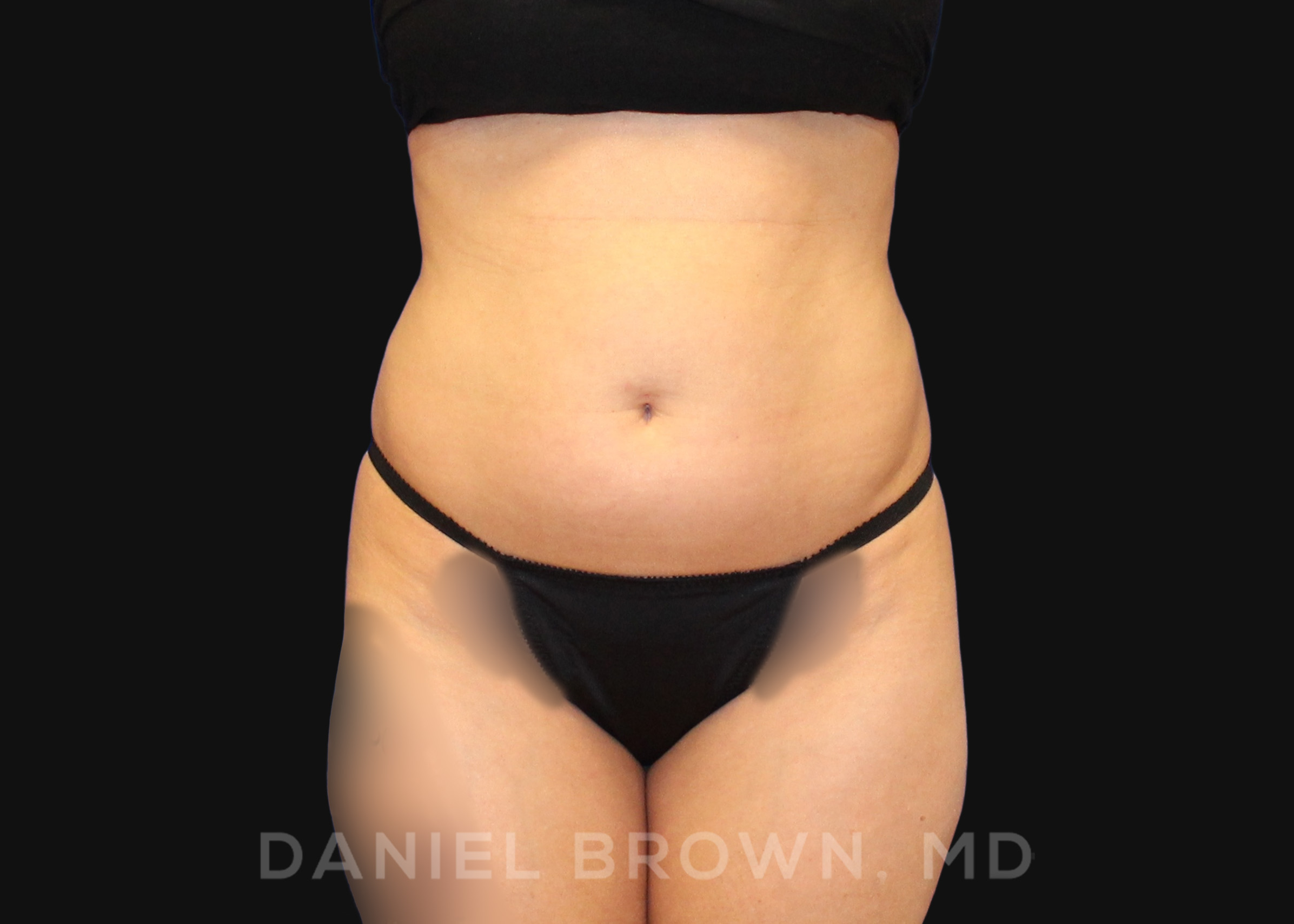 Liposuction Patient Photo - Case 1617 - before view-