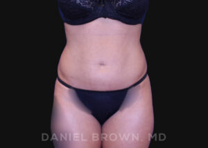 Liposuction - Case 1617 - After