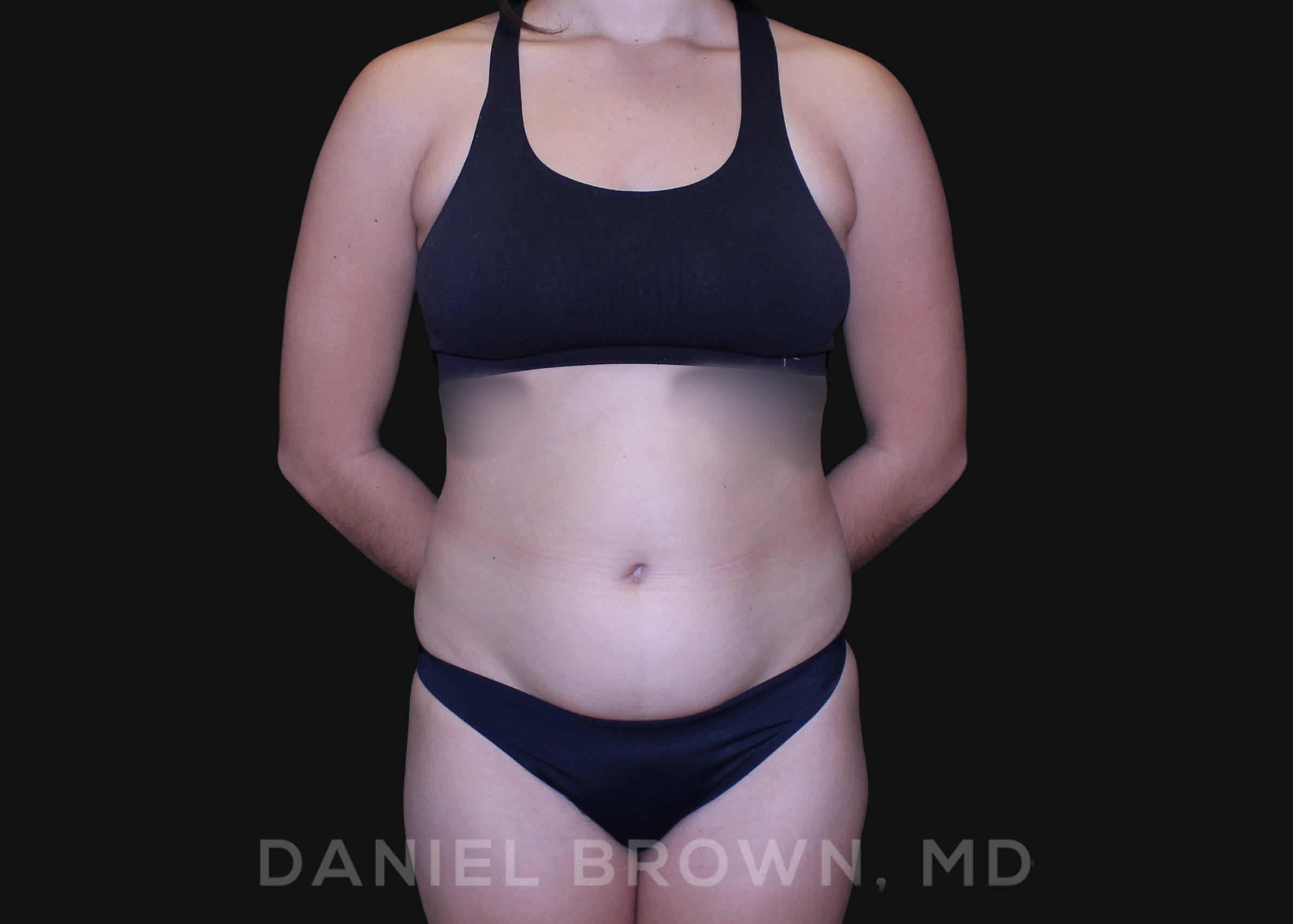 Liposuction Patient Photo - Case 1628 - before view-0