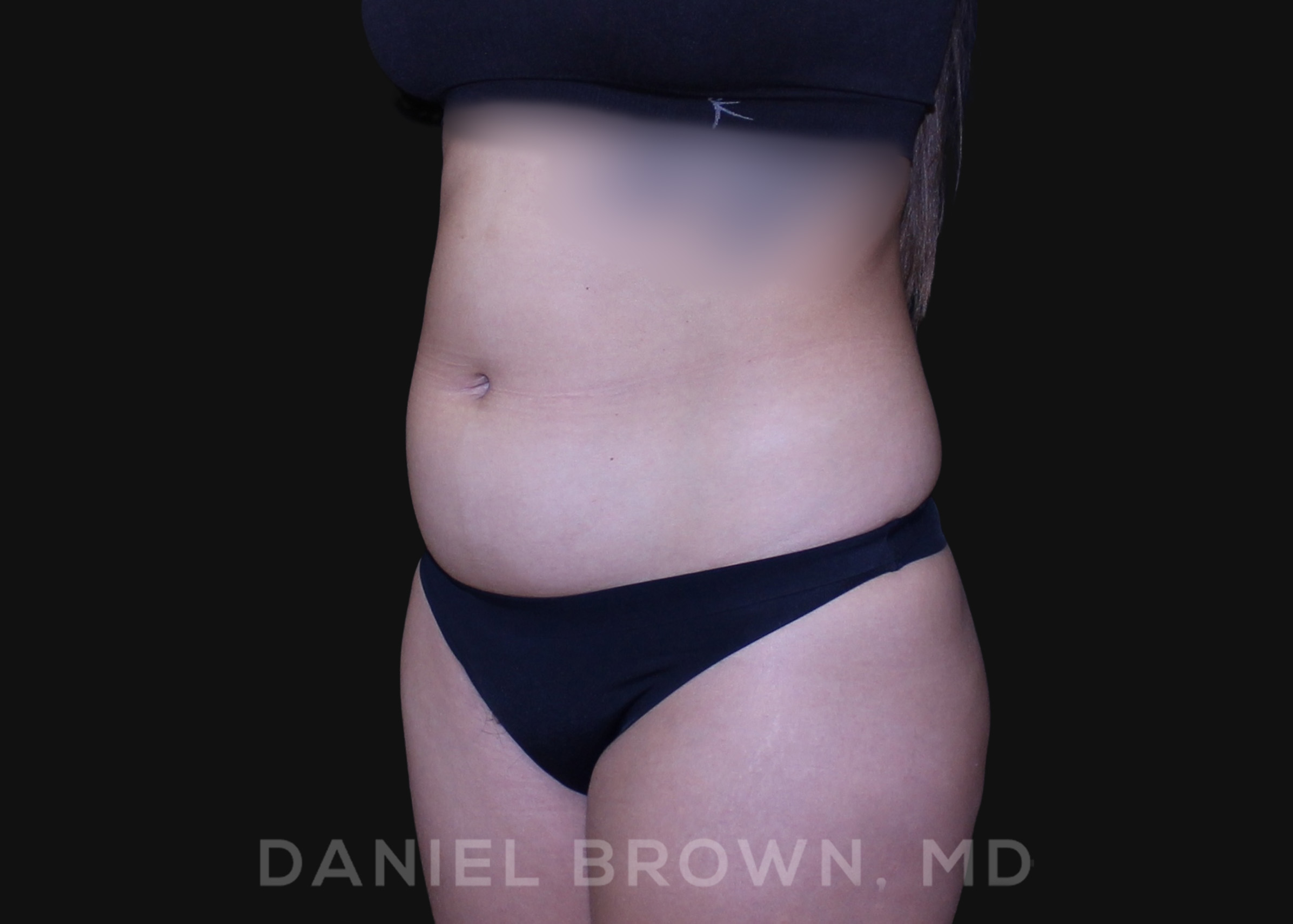 Liposuction Patient Photo - Case 1628 - before view-4
