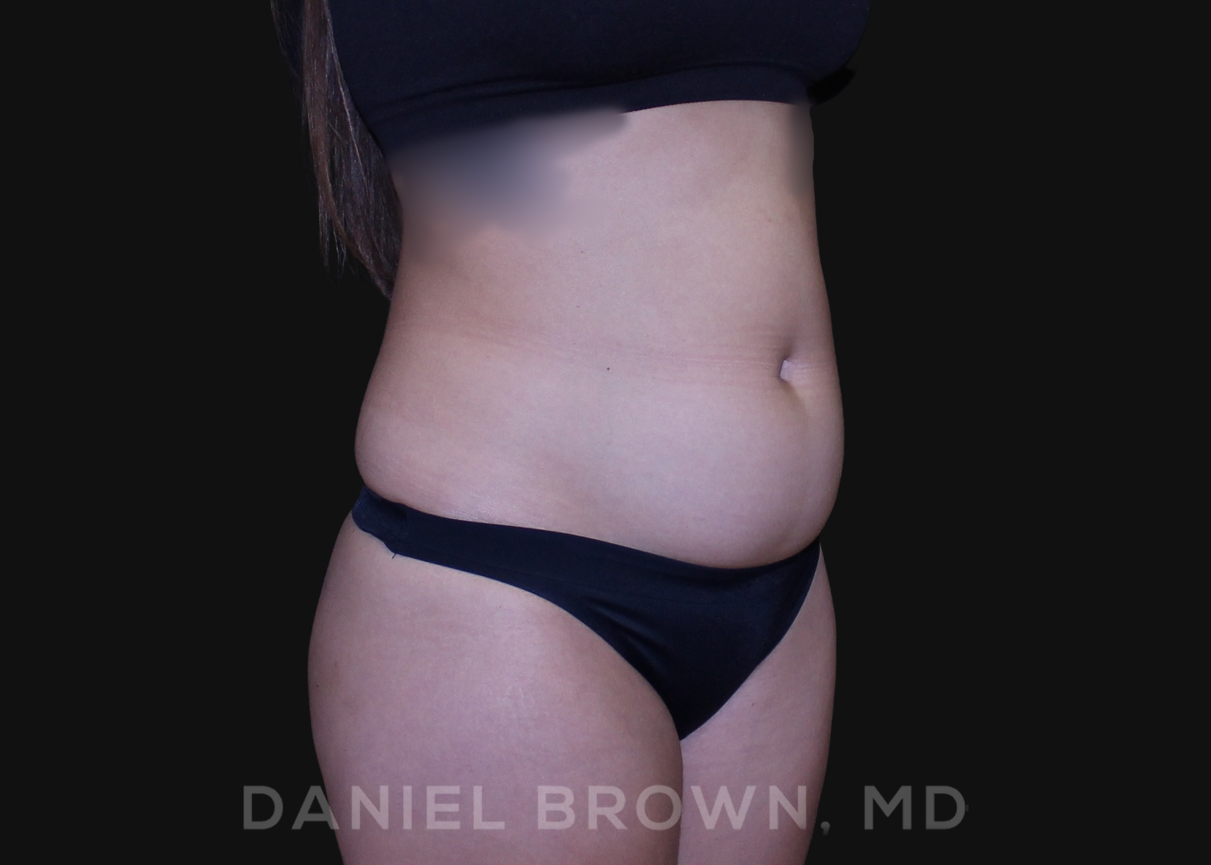 Liposuction Patient Photo - Case 1628 - before view-
