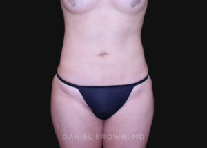 Liposuction - Case 1651 - After
