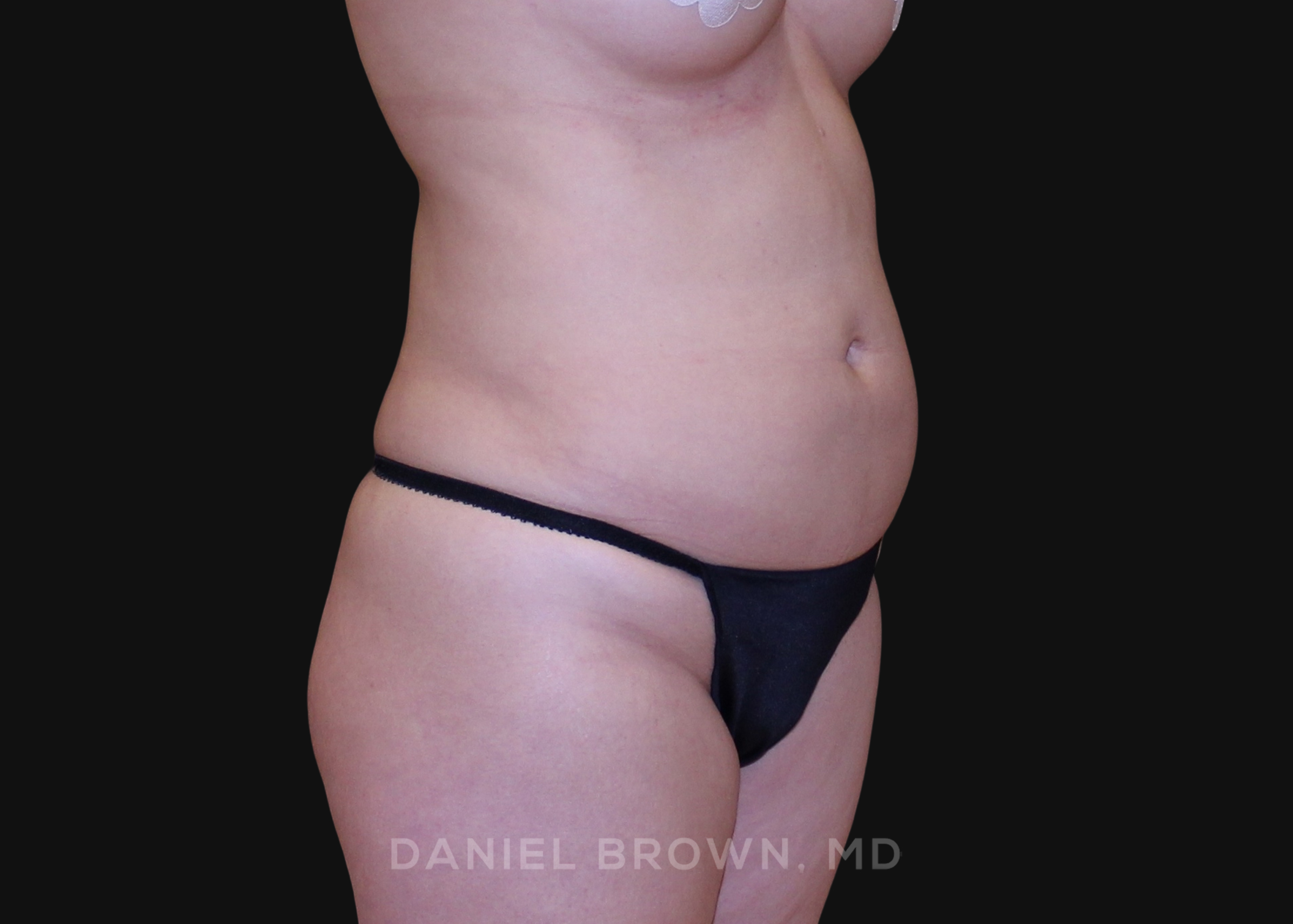 Liposuction Patient Photo - Case 1651 - before view-