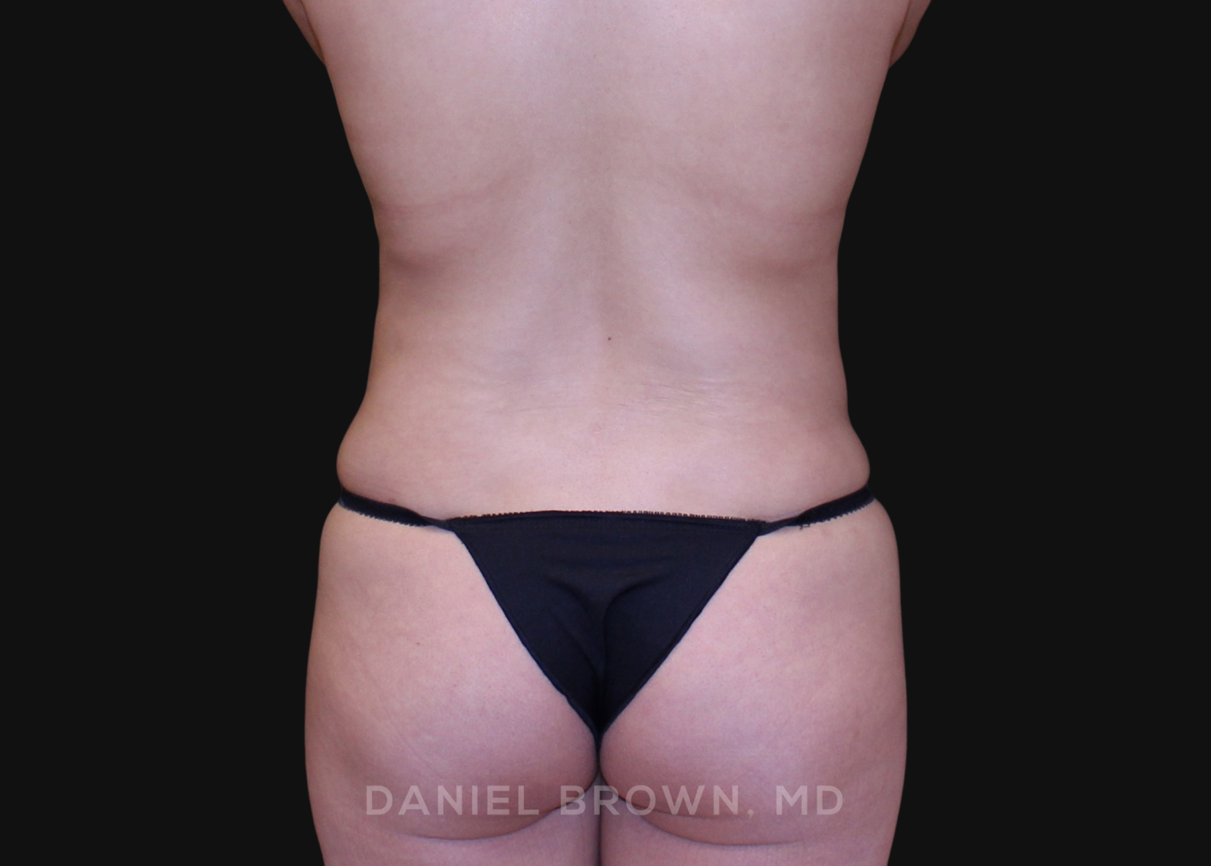Liposuction Patient Photo - Case 1651 - before view-5