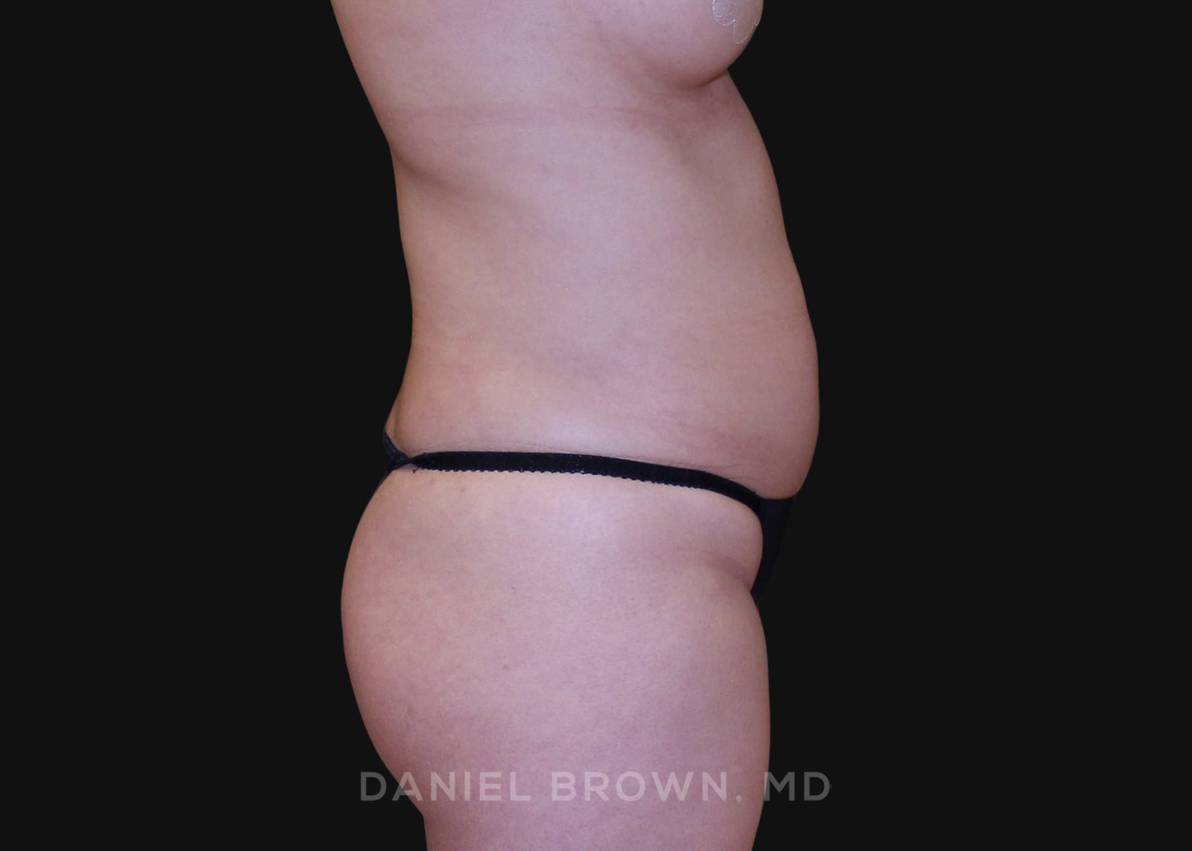Liposuction Patient Photo - Case 1651 - before view-