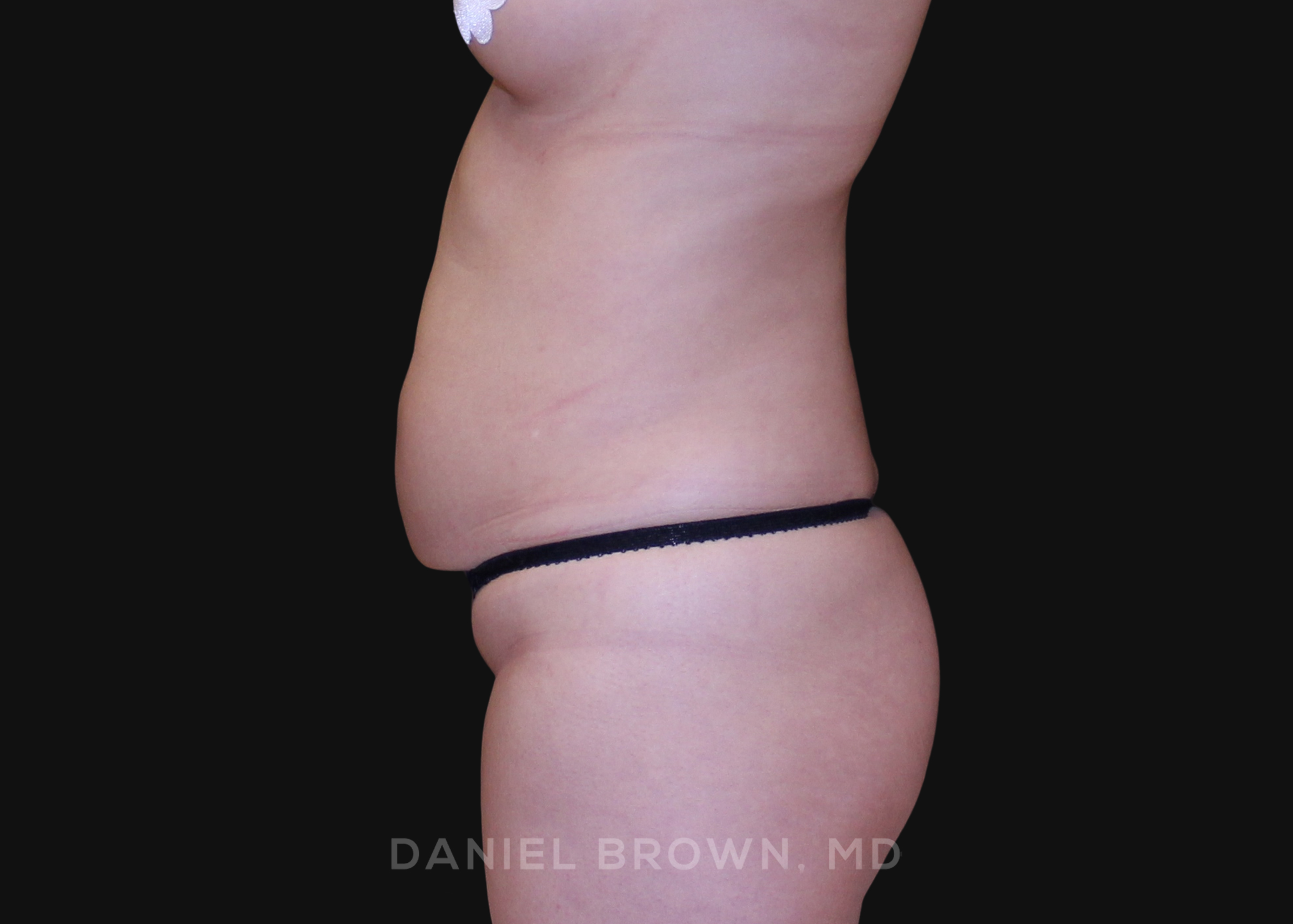 Liposuction Patient Photo - Case 1651 - before view-3