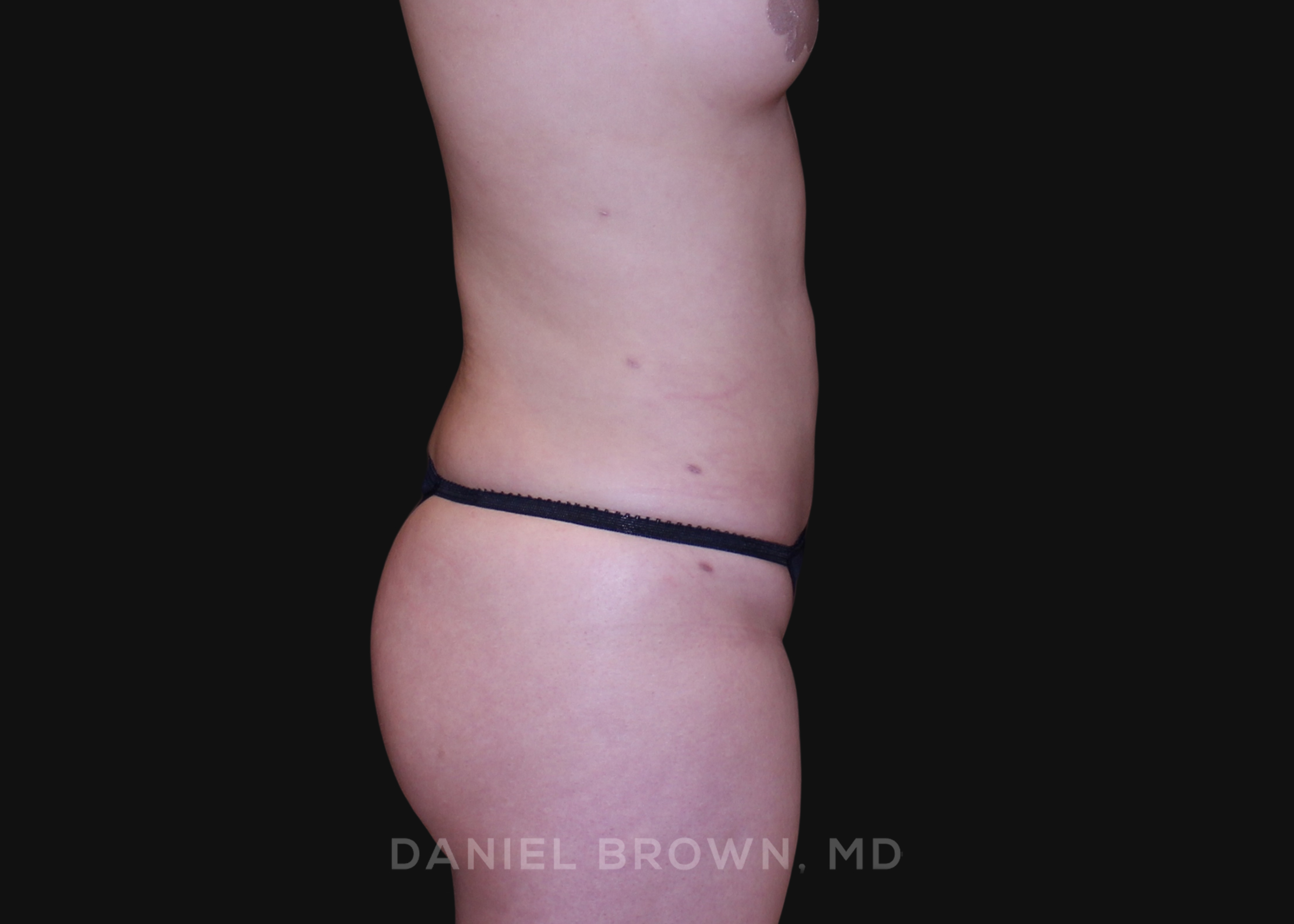 Liposuction Patient Photo - Case 1651 - after view