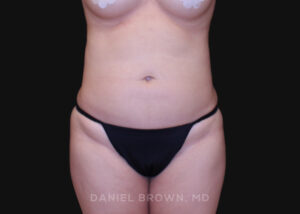Liposuction - Case 1651 - Before