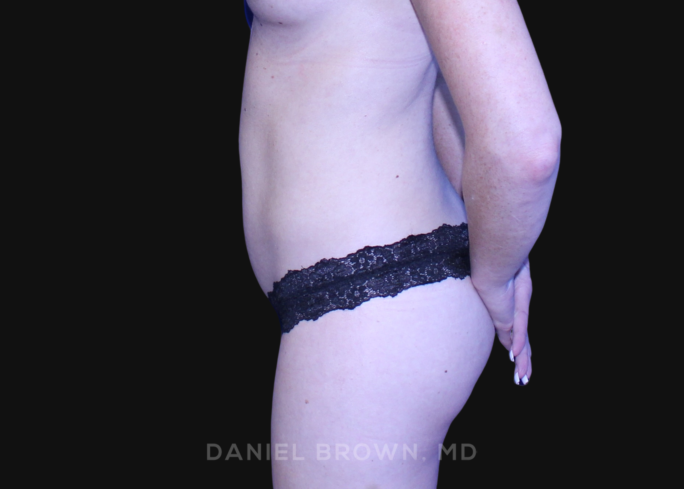 Liposuction Patient Photo - Case 1664 - after view