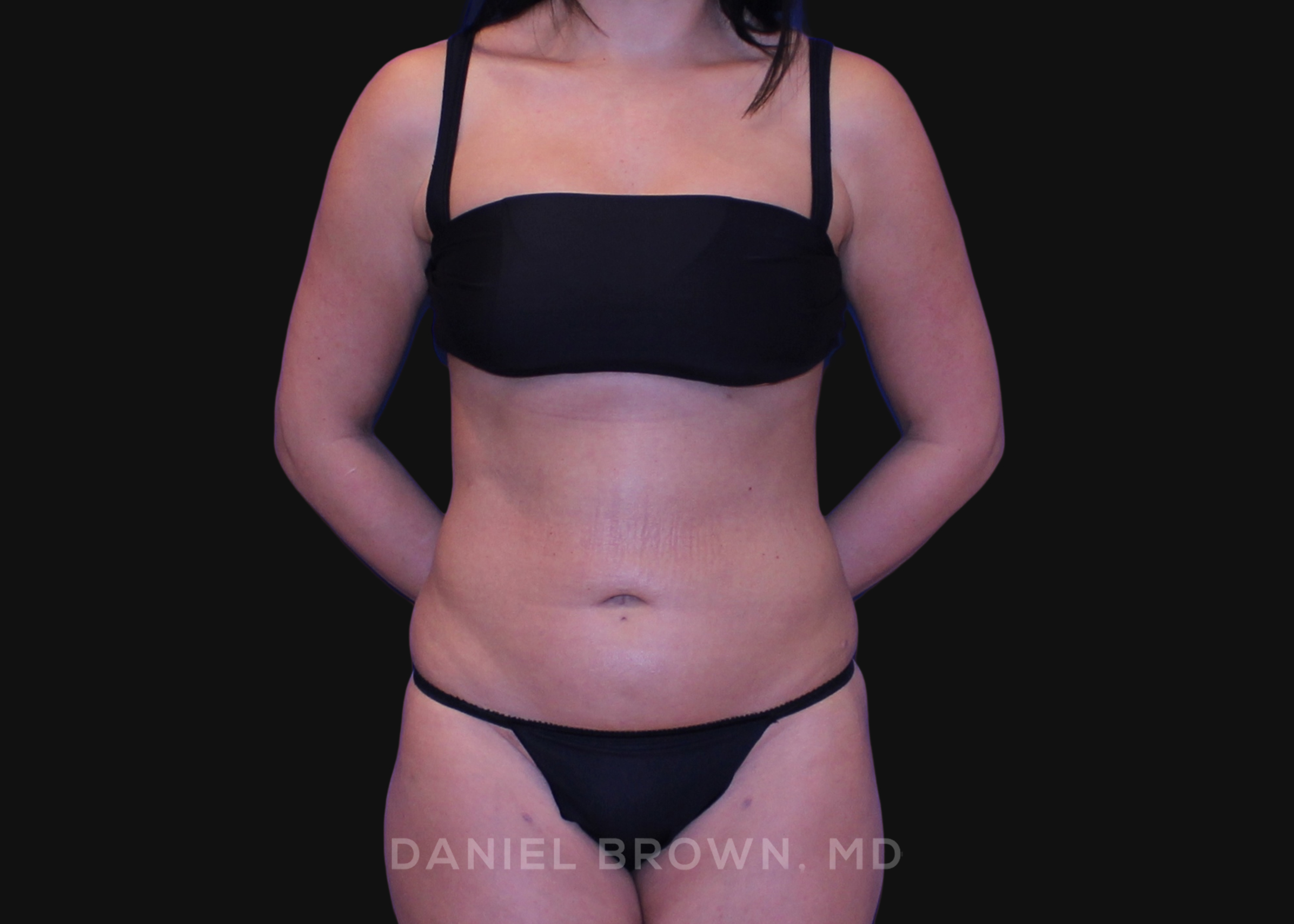 Liposuction Patient Photo - Case 1675 - after view-0