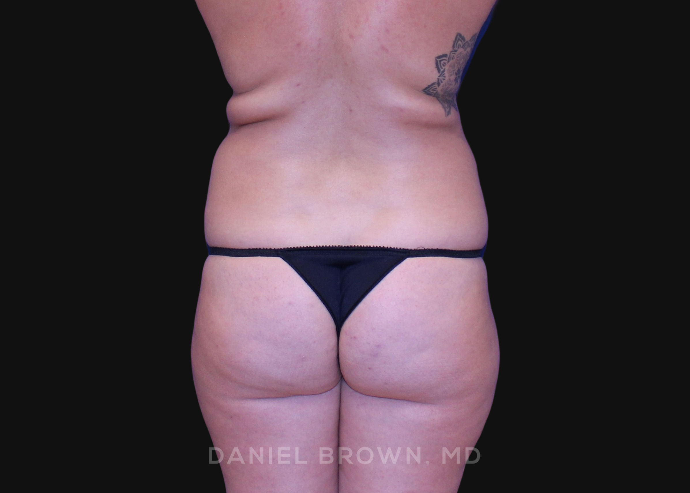 Liposuction Patient Photo - Case 1675 - before view-