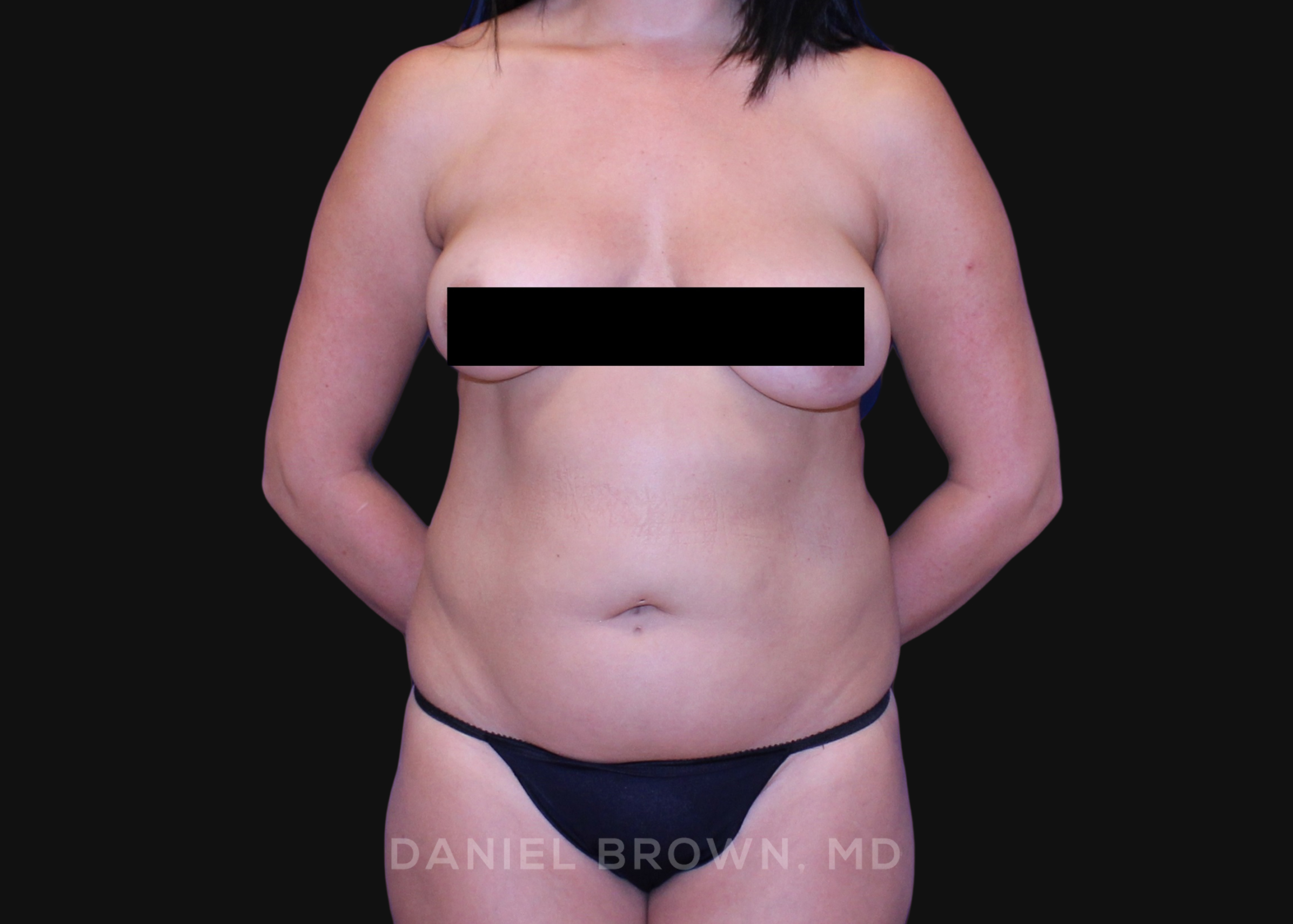 Liposuction Patient Photo - Case 1675 - before view-