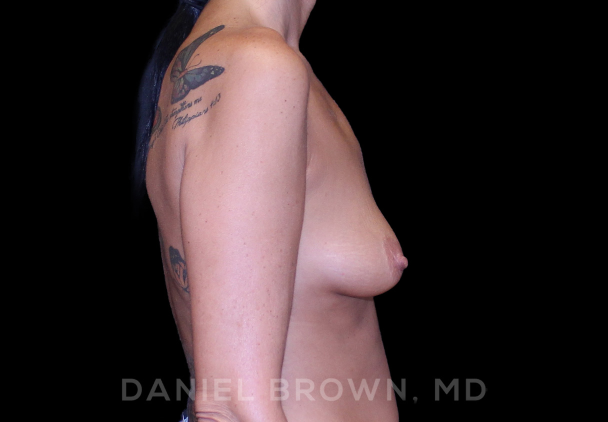 Breast Lift & Implant Patient Photo - Case 1784 - before view-4