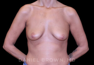 Breast Lift & Implant - Case 1784 - Before