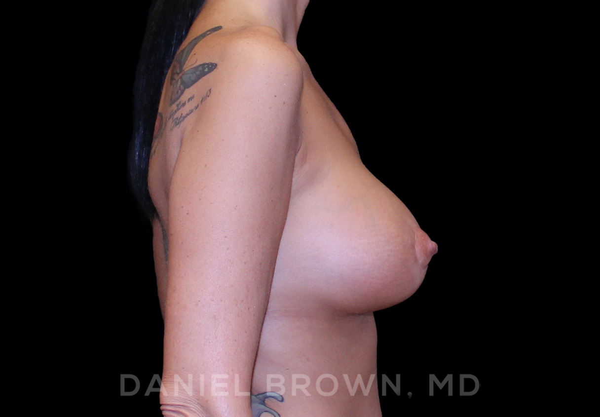 Breast Lift & Implant Patient Photo - Case 1784 - after view-4