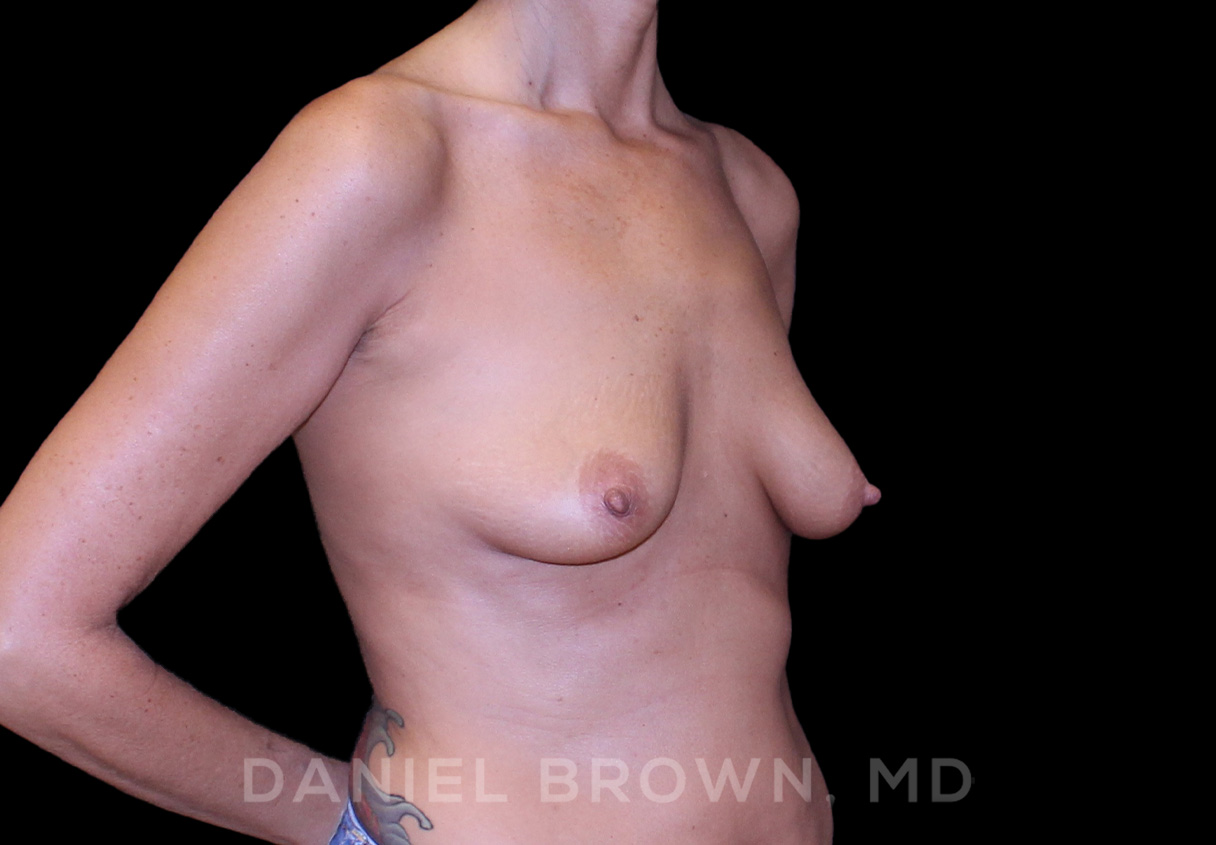 Breast Lift & Implant Patient Photo - Case 1784 - before view-2