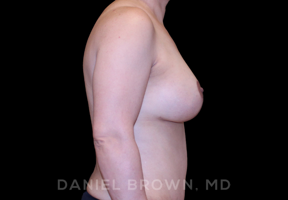 Breast Lift & Implant Patient Photo - Case 1795 - after view