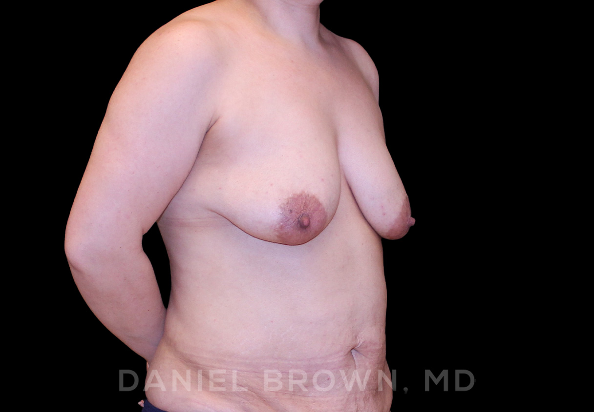 Breast Lift & Implant Patient Photo - Case 1795 - before view-2
