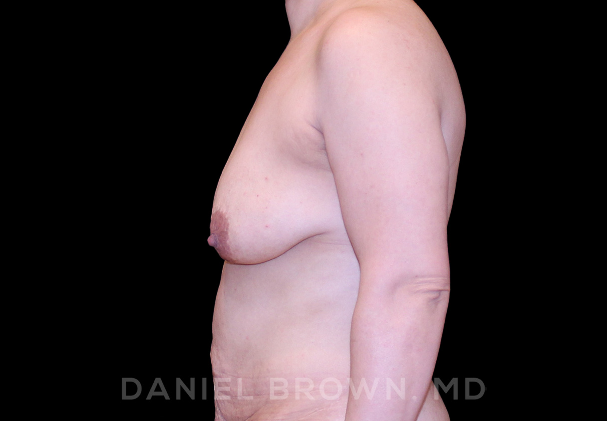 Breast Lift & Implant Patient Photo - Case 1795 - before view-3