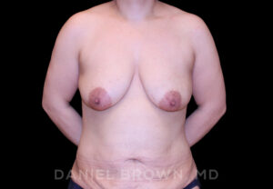 Breast Lift & Implant - Case 1795 - Before