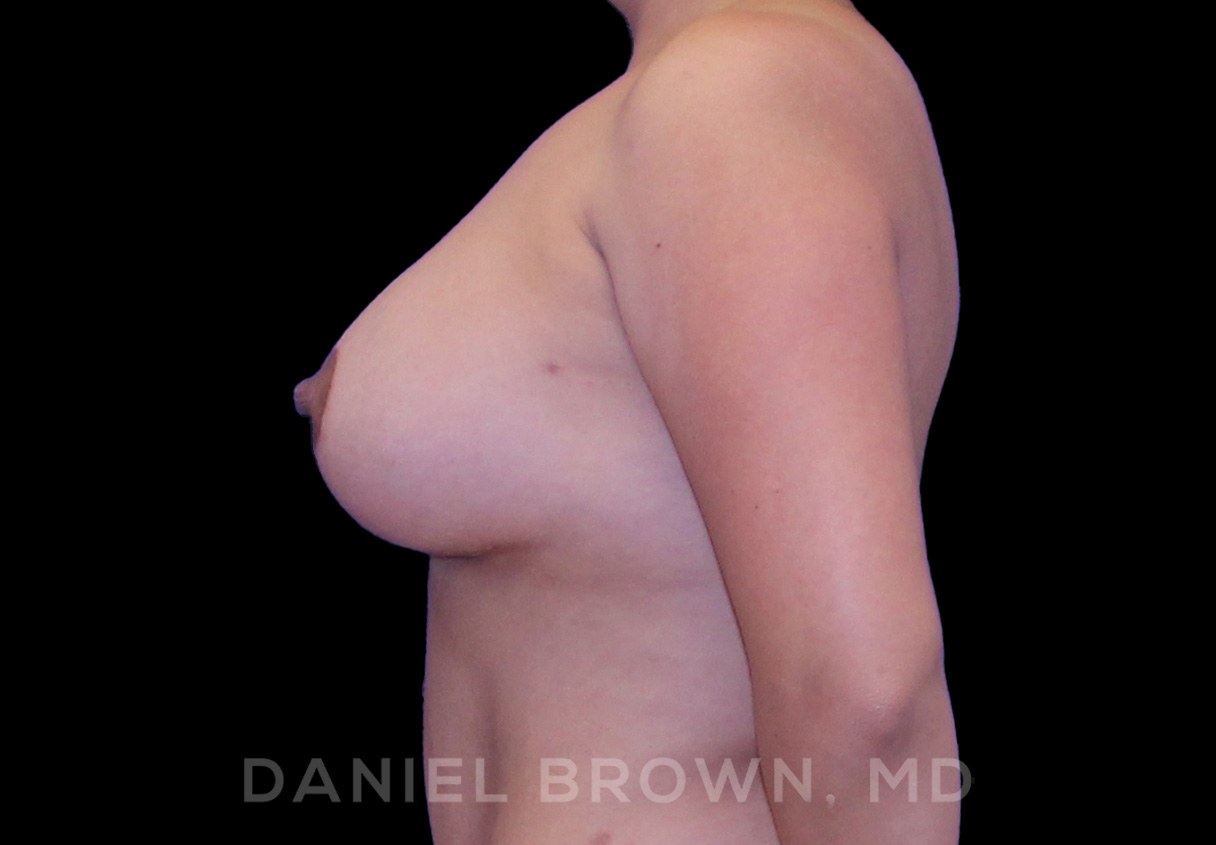 Breast Lift & Implant Patient Photo - Case 1806 - after view