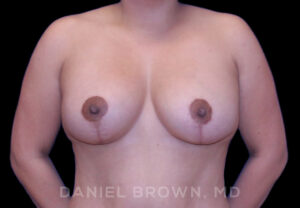 Breast Lift & Implant - Case 1806 - After