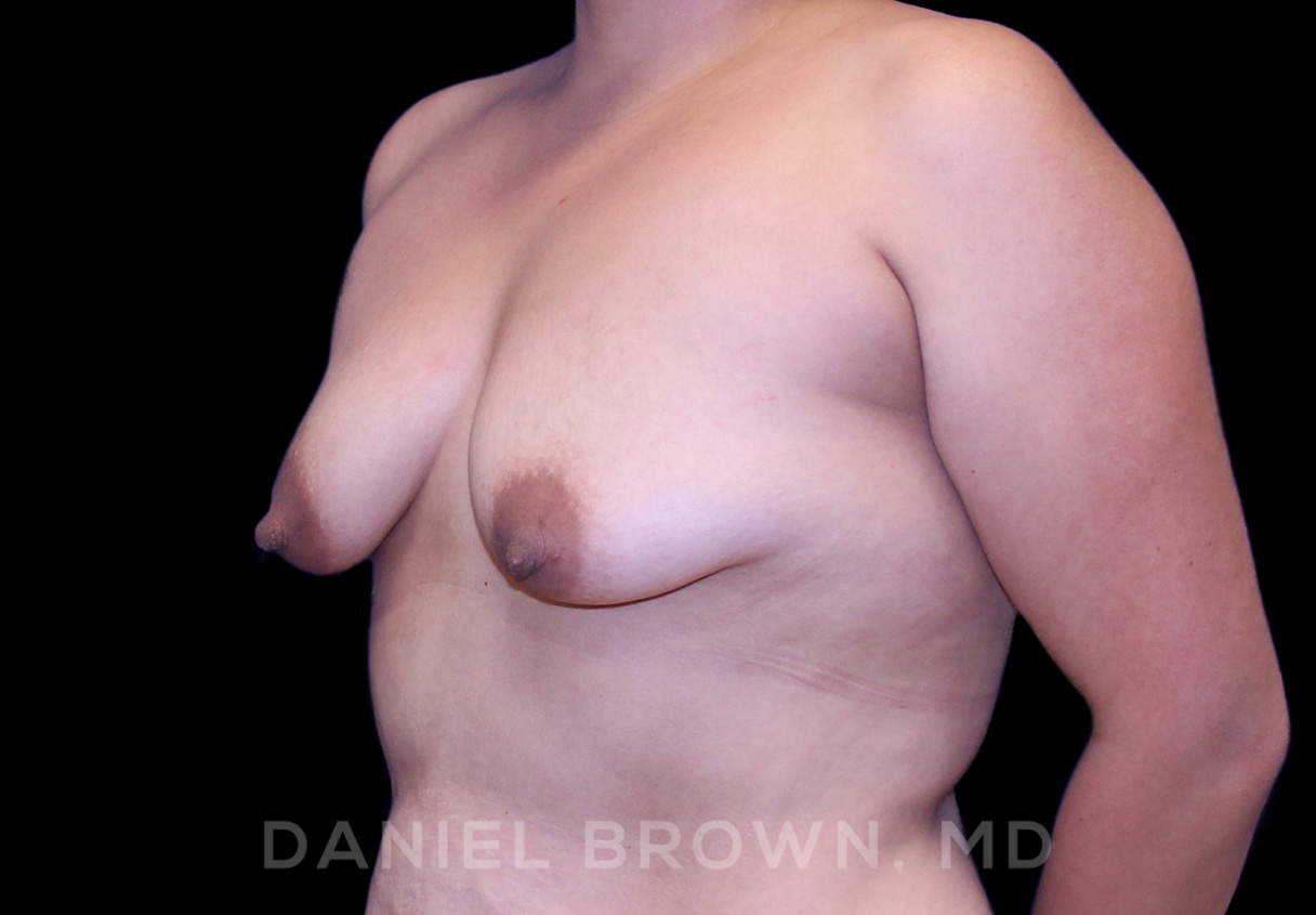 Breast Lift & Implant Patient Photo - Case 1806 - before view-