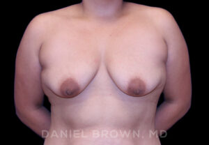 Breast Lift & Implant - Case 1806 - Before